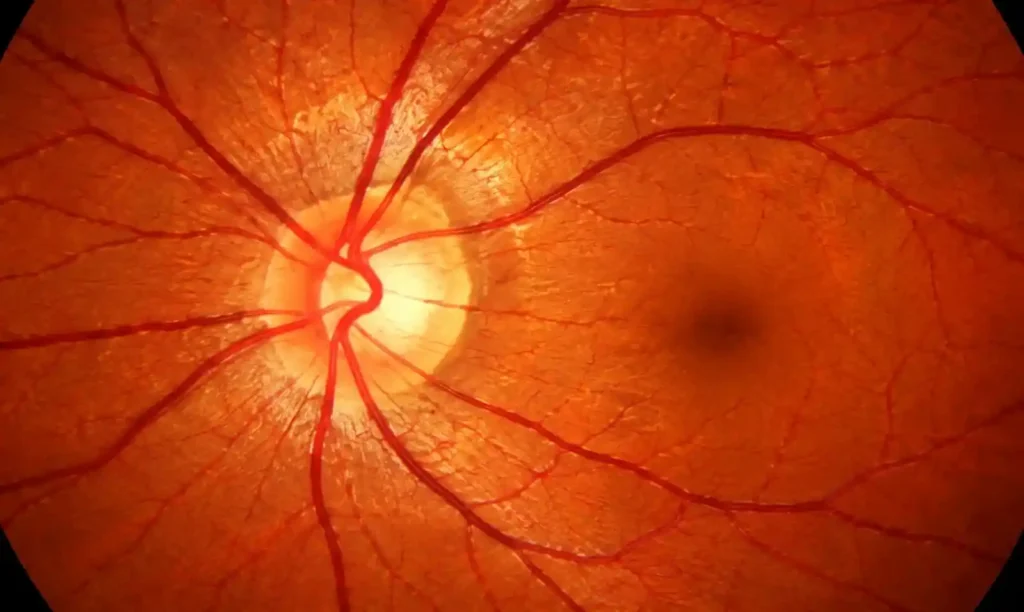 retina test