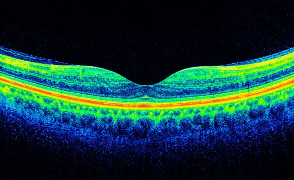 retina test